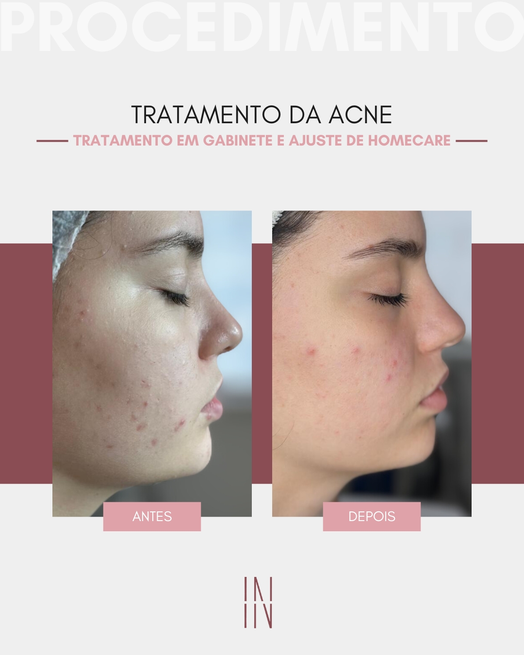 IN_Resultado Clínico_Acne (4)